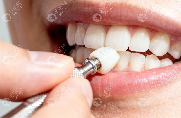 无锡贝壳口腔种植牙价格多少钱？韩国登腾种植体+全瓷牙冠套餐真实测评