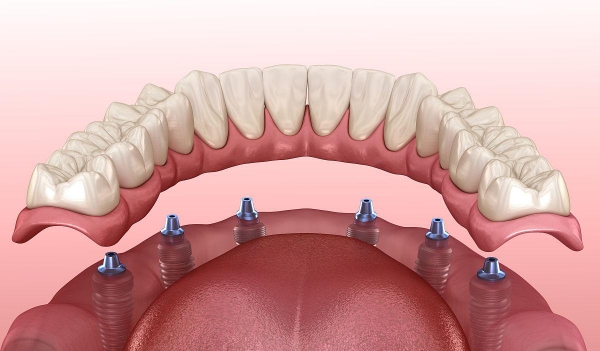 四、韶关和正口腔种植牙价格表的核心价格区间参考