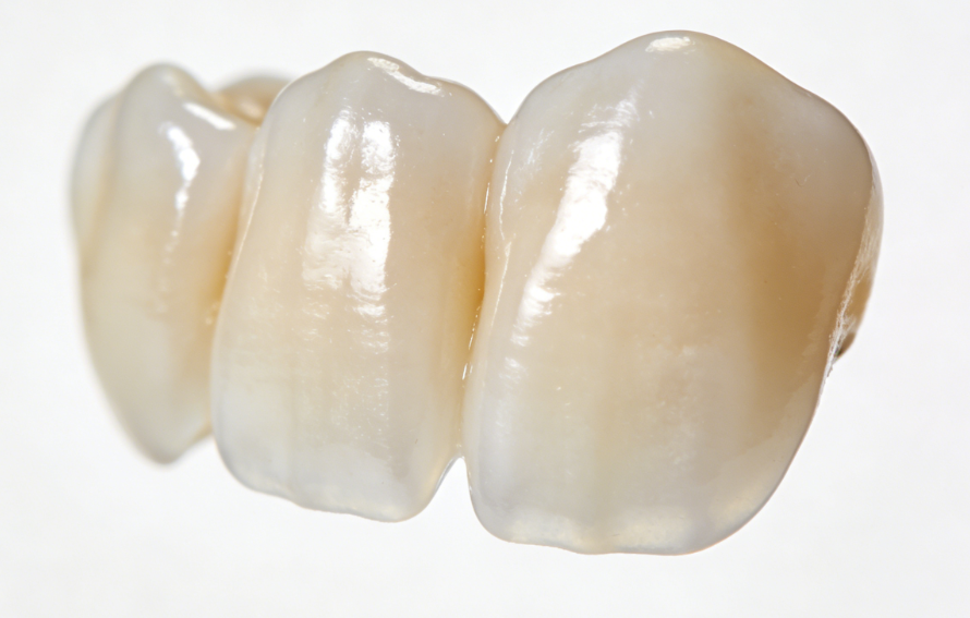 虎牙全瓷牙矫正