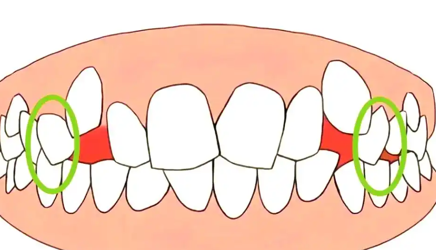 三、虎牙全瓷牙矫正适用于哪些情况？