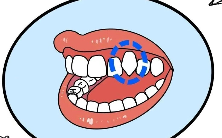 五、苏州哪里可以做虎牙全瓷牙矫正？