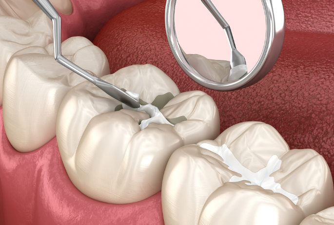 二、美学树脂补牙的医院选择要点