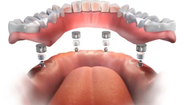 七、靖江雅固仕口腔：专注种植与修复的专门机构