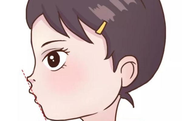 小孩地包天矫正