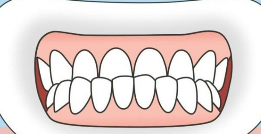 小孩地包天矫正牙齿的全部过程，4个阶段治疗时间表请收好