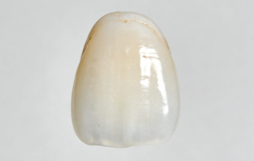 大连康贝佳口腔牙贴面价格明细，全口瓷贴面美白16790元起性价比较高，超值