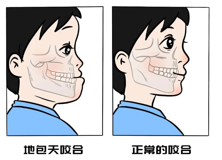 五、地包天有哪些矫正方式?