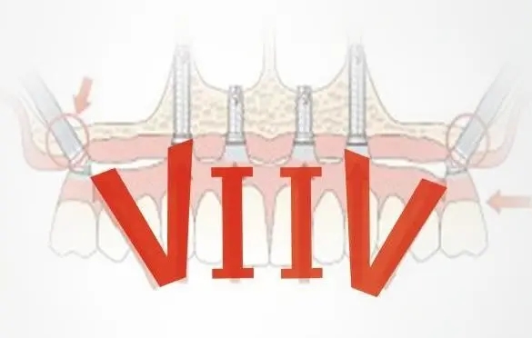 五、选择利多齿种植牙有哪些注意事项？
