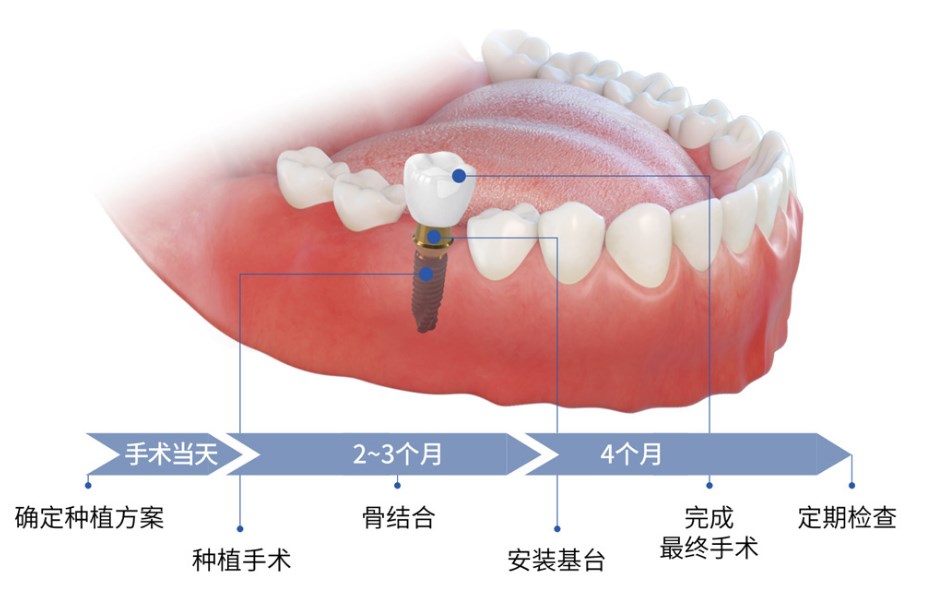 五、我的建议:别因小怕大,耽误修复黄金期