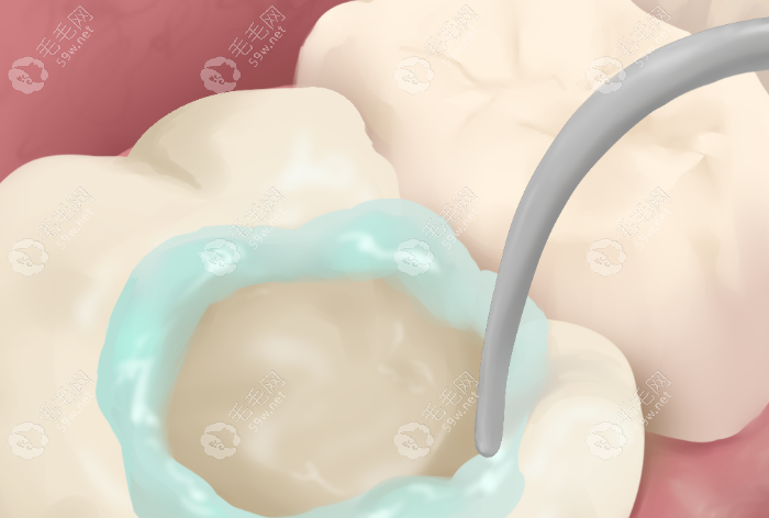 美学树脂充填术