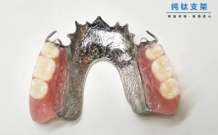 四、PEEK支架假牙的后期维护难吗？