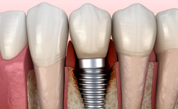 多颗缺牙怎么办？从6颗韩国种植牙价格到全口义齿修复，医生在线支招