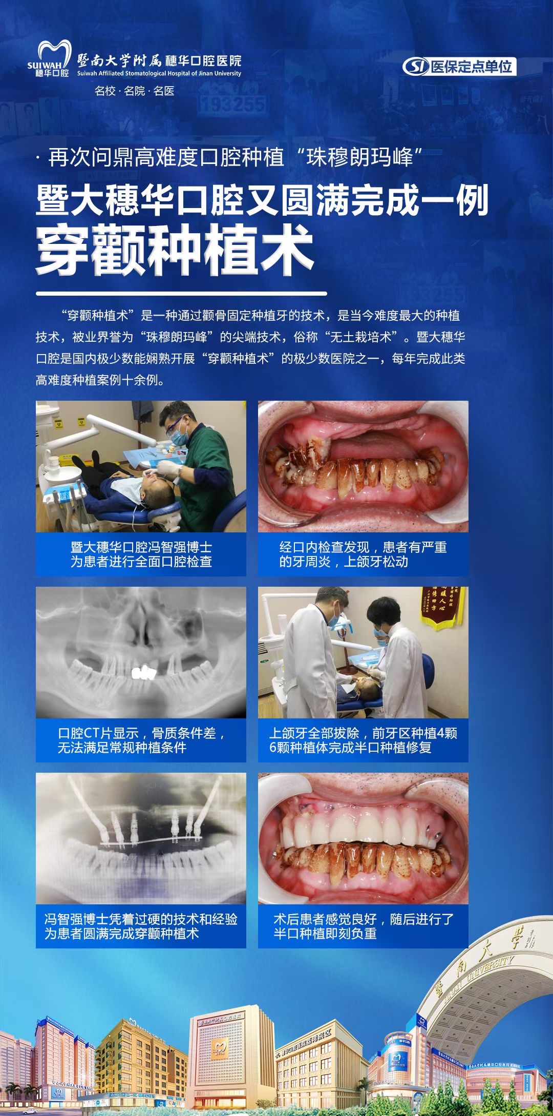 广州穗华口腔医院种牙靠谱吗？走访三家诊所后，我终于在穗华把牙给种了