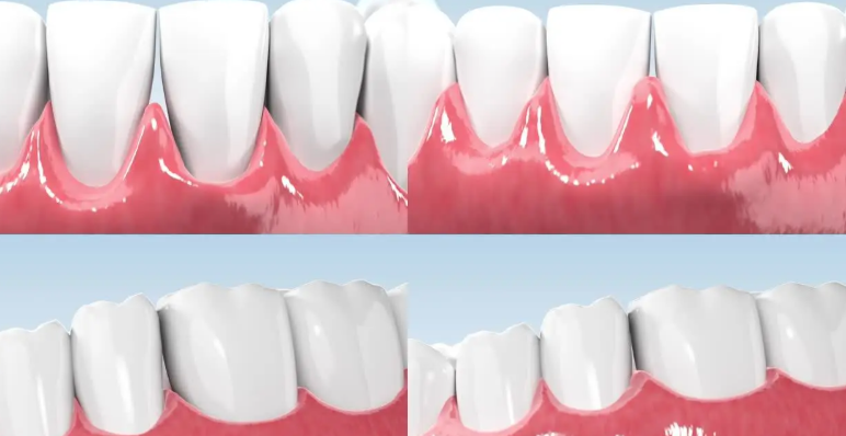 七、牙龈萎缩是咋回事，什么时候一定要去看医生