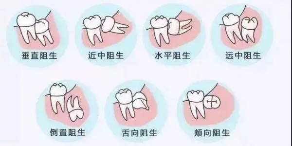 坐标吉林！张杰口腔拔智齿体验分享，原来可以这么安心舒适