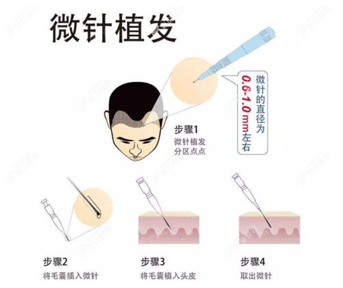 七、发际线种植的真实经历:三个月后的初步变化
