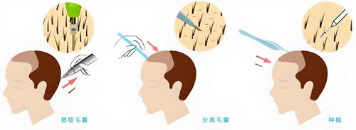 五、发际线种植的真实经历:术后前几天的变好状态