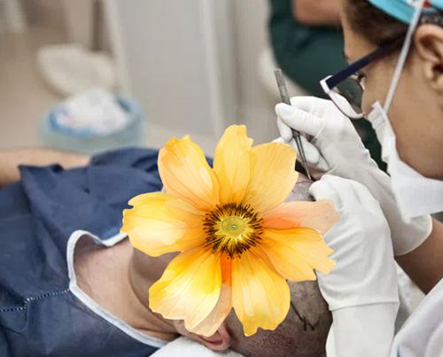 九、发际线种植的真实经历:值不值得做的真实想法