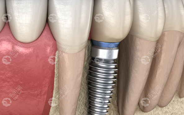  精细的种植修复技术专长