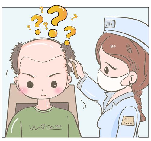 四、种植发际线