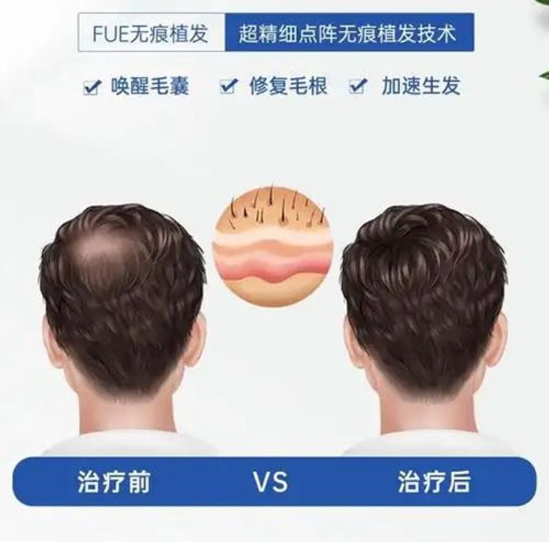 关于大麦微针植发疗效与价格的客观分析