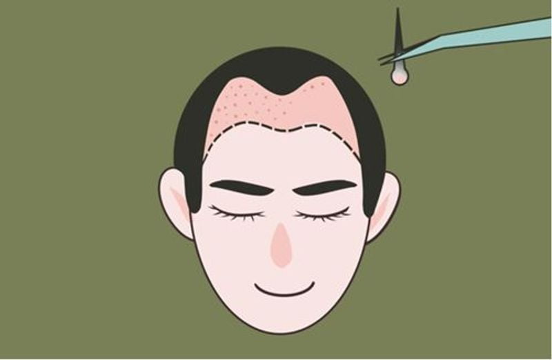如何选择靠谱的大麦微针植发医生与机构