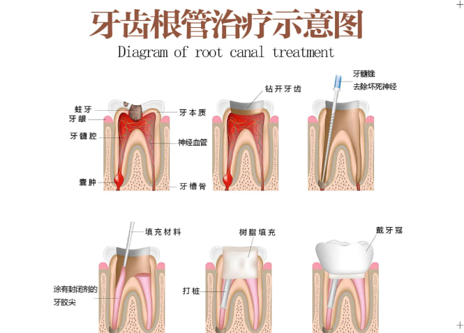 西安质诚口腔根管治疗费用到底贵不贵？亲测不割韭菜，单颗价格980-2200元起