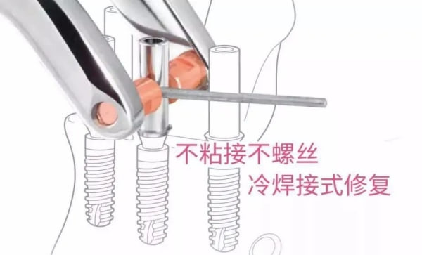 一、 杭州富阳添齿口腔和富阳口腔医院种牙技术到底哪个好?