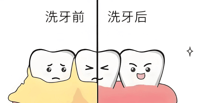 二、为何洁牙后抛光对烟渍茶渍人群尤为重要?