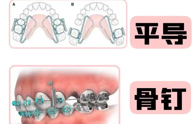 衡水可恩口腔隐形矫正怎么样？口扫预览终态，戴半年侧脸线条先变顺