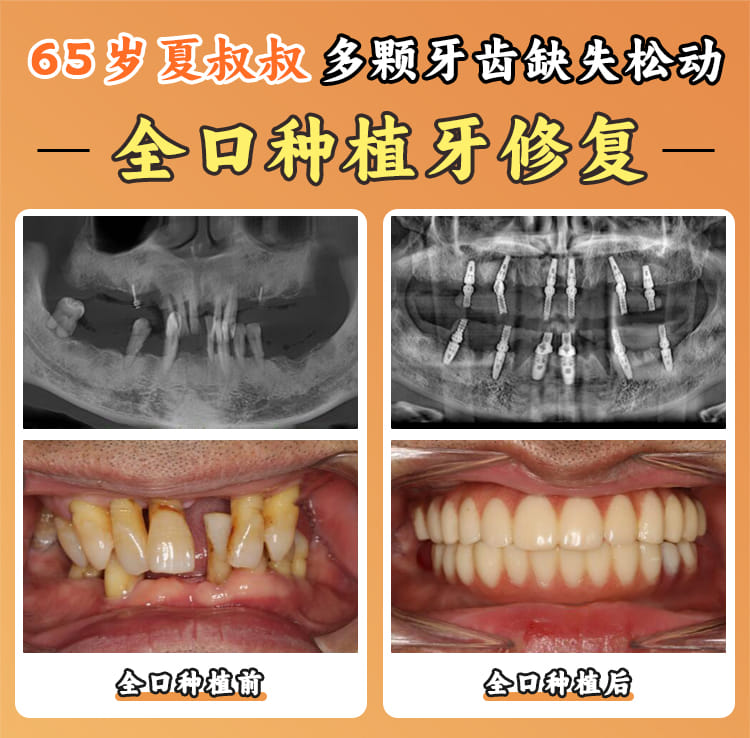 二、上海良美口腔门诊部赵大鹏医生的3D导板种植技术怎么样
