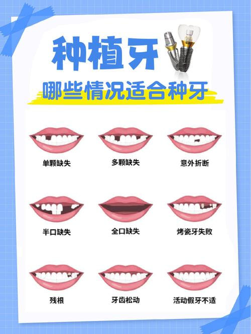 二、春诚口腔种植牙三千元起能覆盖哪些缺牙情况